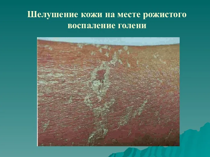 Шелушение кожи на месте рожистого воспаление голени