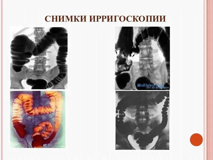 СНИМКИ ИРРИГОСКОПИИ