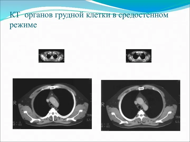 КТ органов грудной клетки в средостенном режиме