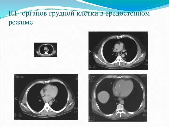 КТ органов грудной клетки в средостенном режиме