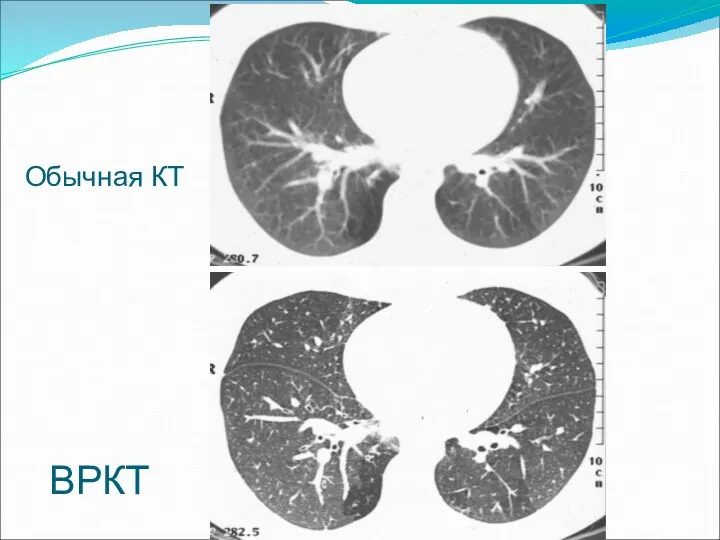 Обычная КТ ВРКТ