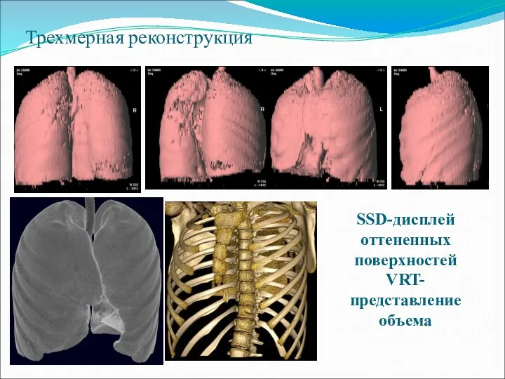 Трехмерная реконструкция SSD-дисплей оттененных поверхностей VRT-представление объема