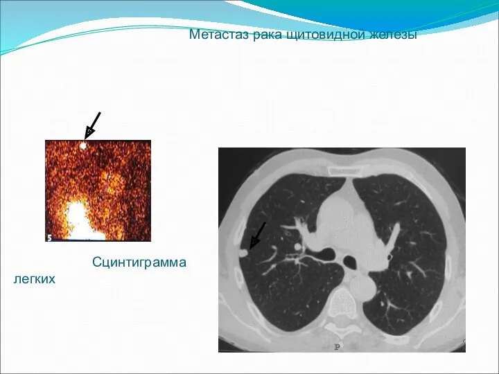 Сцинтиграмма легких Метастаз рака щитовидной железы