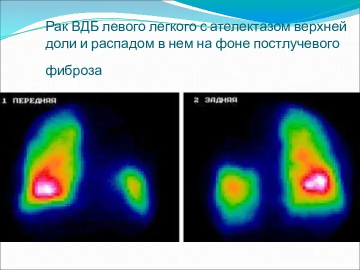 Рак ВДБ левого легкого с ателектазом верхней доли и распадом в нем на фоне постлучевого фиброза