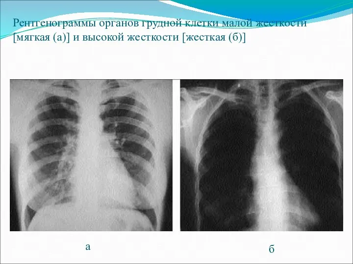 Рентгенограммы органов грудной клетки малой жесткости [мягкая (а)] и высокой жесткости [жесткая (б)] а б