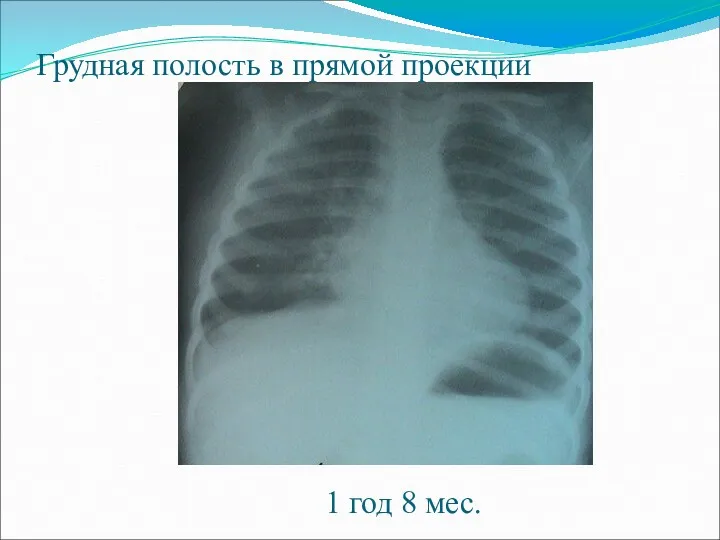 Грудная полость в прямой проекции 1 год 8 мес.