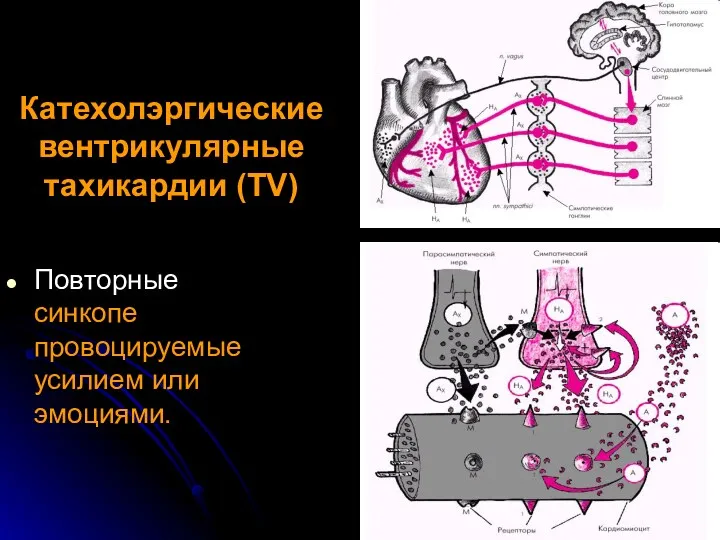 Катехолэргические вентрикулярные тахикардии (TV) Повторные синкопе провоцируемые усилием или эмоциями.