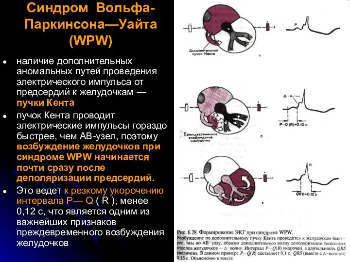 Синдром Вольфа-Паркинсона—Уайта (WPW) наличие дополнительных аномальных путей проведения электрического импульса от предсердий к