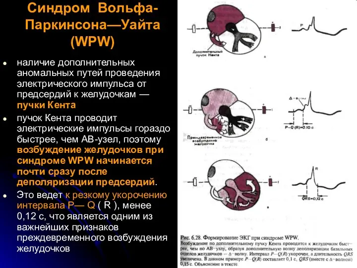 Синдром Вольфа-Паркинсона—Уайта (WPW) наличие дополнительных аномальных путей проведения электрического импульса