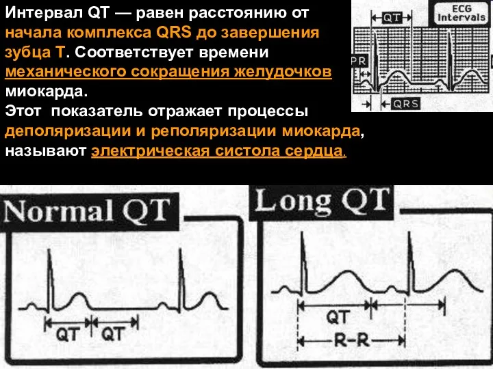 Интервал QT — равен расстоянию от начала комплекса QRS до завершения зубца T.
