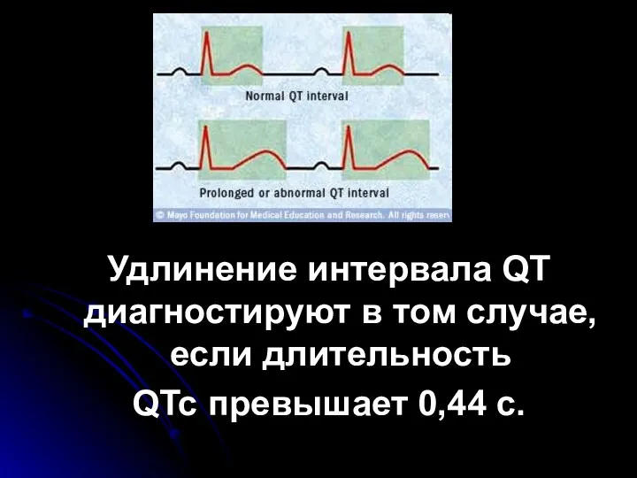 Удлинение интервала QT диагностируют в том случае, если длительность QTc превышает 0,44 с.