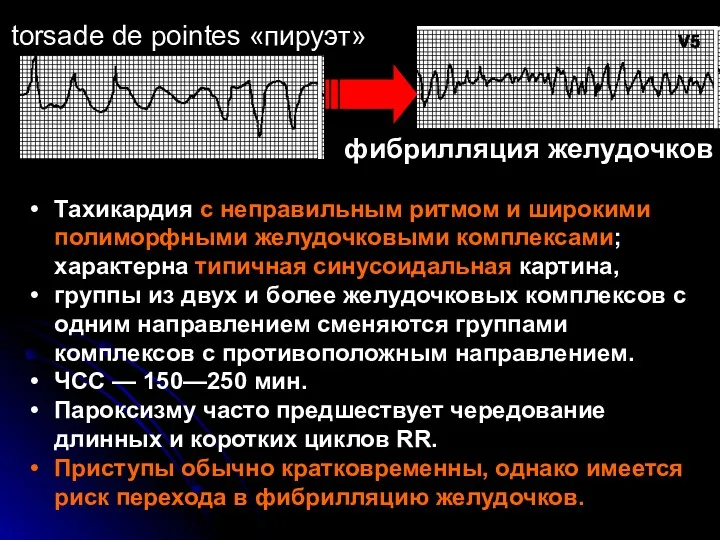 Тахикардия с неправильным ритмом и широкими полиморфными желудочковыми комплексами; характерна типичная синусоидальная картина,