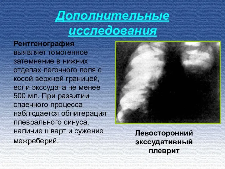 Дополнительные исследования Рентгенография выявляет гомогенное затемнение в нижних отделах легочного