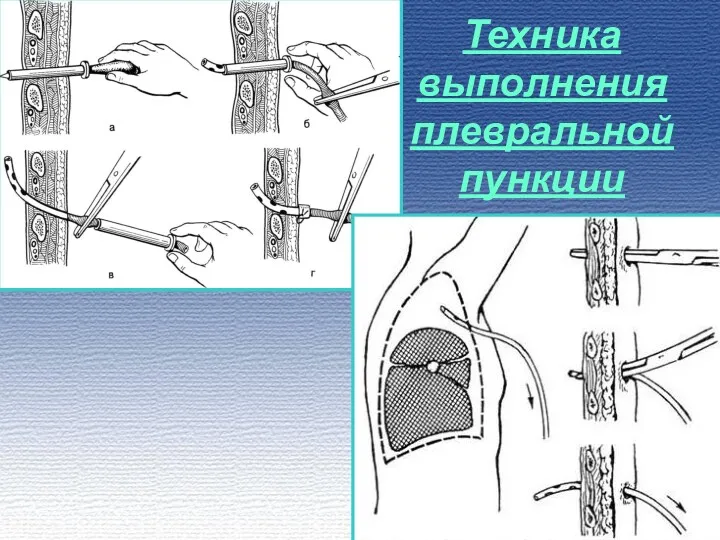 Техника выполнения плевральной пункции