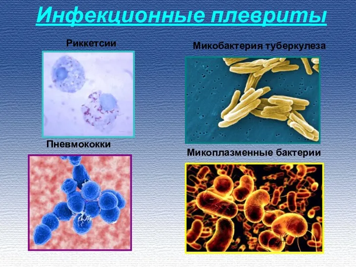 Инфекционные плевриты Пневмококки Микобактерия туберкулеза Риккетсии Микоплазменные бактерии