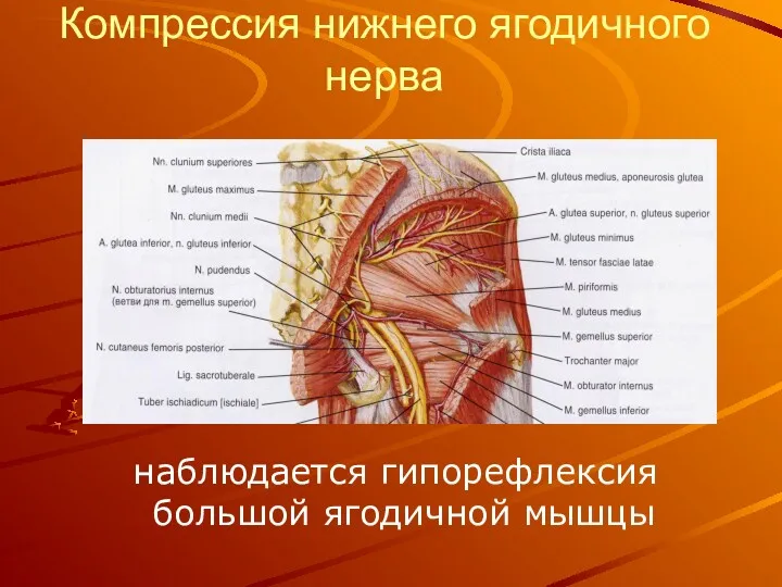 Компрессия нижнего ягодичного нерва наблюдается гипорефлексия большой ягодичной мышцы