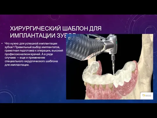 ХИРУРГИЧЕСКИЙ ШАБЛОН ДЛЯ ИМПЛАНТАЦИИ ЗУБОВ Что нужно для успешной имплантации