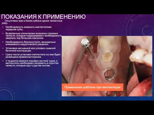 ПОКАЗАНИЯ К ПРИМЕНЕНИЮ Отсутствие трех и более зубов в одном