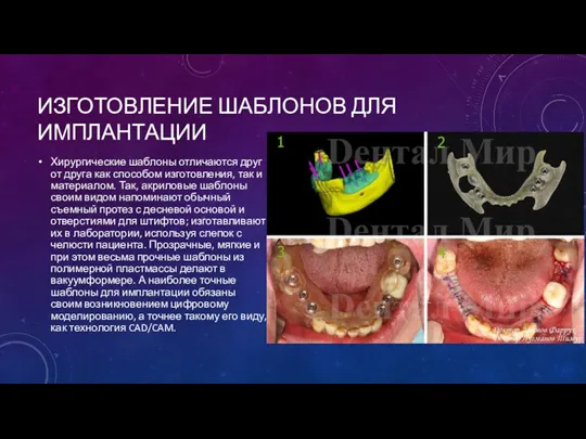 ИЗГОТОВЛЕНИЕ ШАБЛОНОВ ДЛЯ ИМПЛАНТАЦИИ Хирургические шаблоны отличаются друг от друга