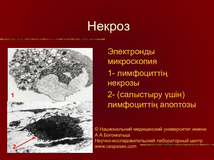 Некроз Электронды микроскопия 1- лимфоциттің некрозы 2- (салыстыру үшін) лимфоциттің