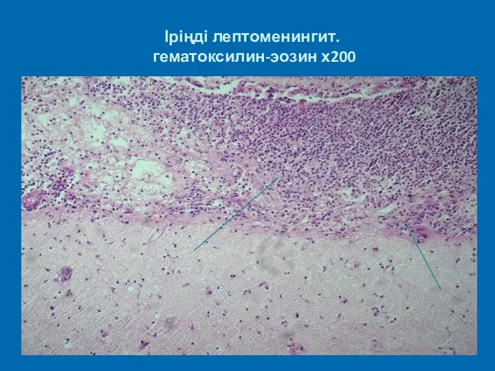 Іріңді лептоменингит. гематоксилин-эозин х200