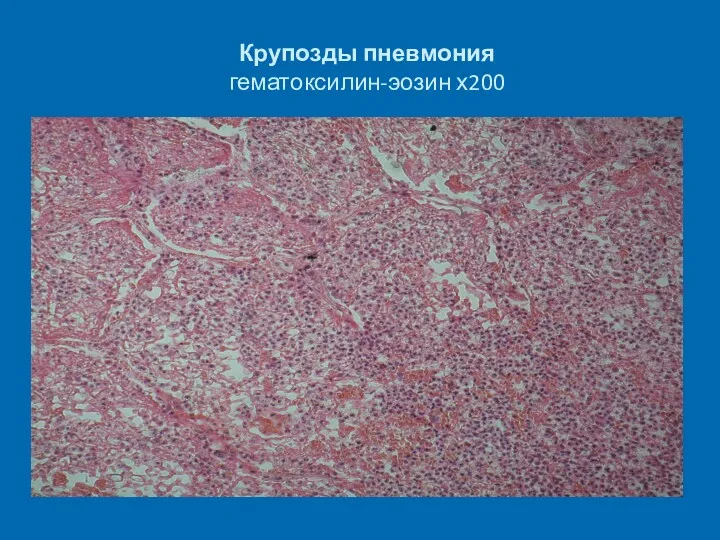 Крупозды пневмония гематоксилин-эозин х200