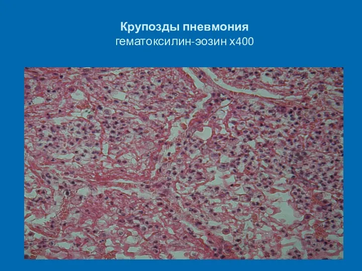 Крупозды пневмония гематоксилин-эозин х400