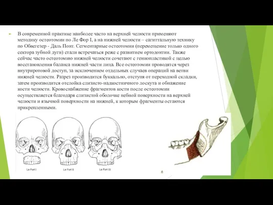 В современной практике наиболее часто на верхней челюсти применяют методику остеотомии по Ле