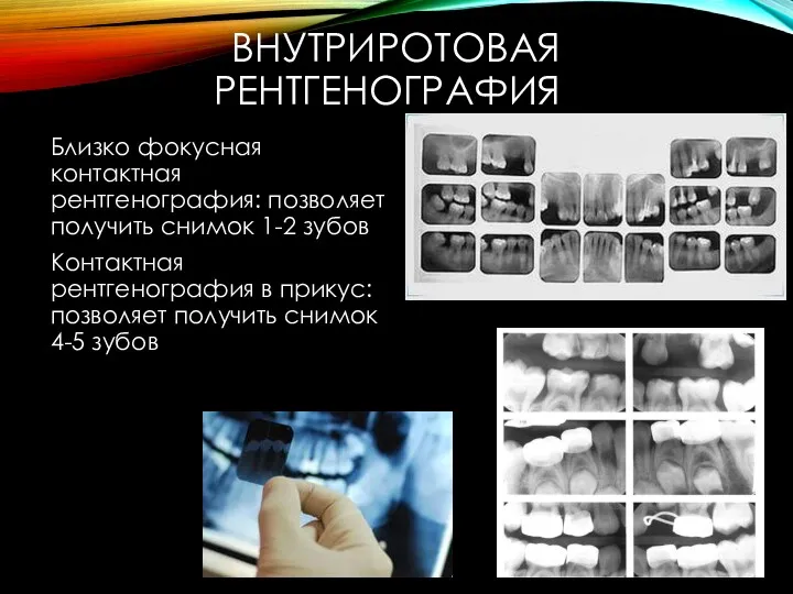 ВНУТРИРОТОВАЯ РЕНТГЕНОГРАФИЯ Близко фокусная контактная рентгенография: позволяет получить снимок 1-2 зубов Контактная рентгенография