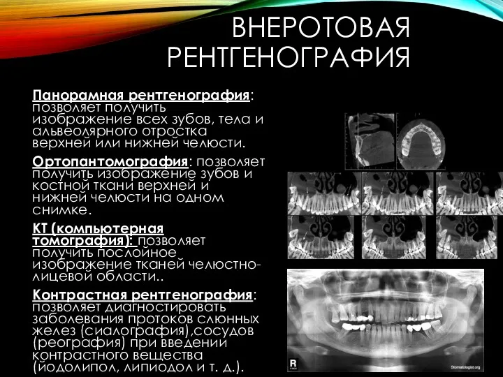 ВНЕРОТОВАЯ РЕНТГЕНОГРАФИЯ Панорамная рентгенография: позволяет получить изображение всех зубов, тела и альвеолярного отростка