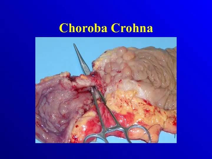 Choroba Crohna