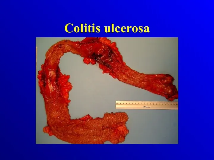 Colitis ulcerosa