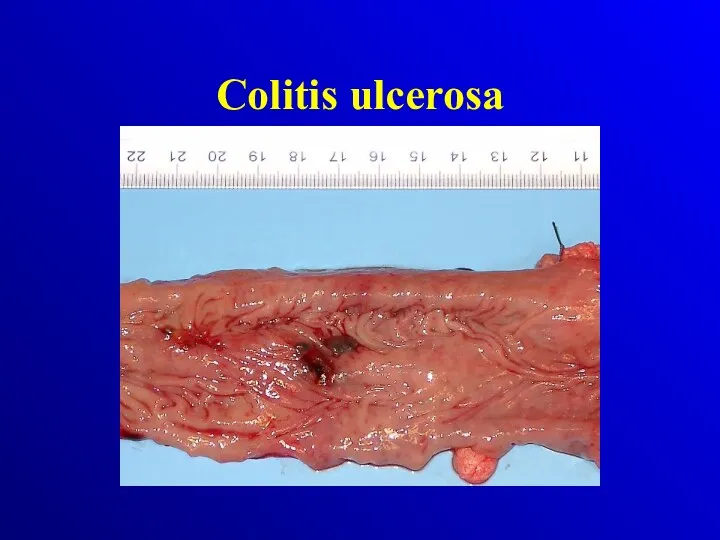 Colitis ulcerosa