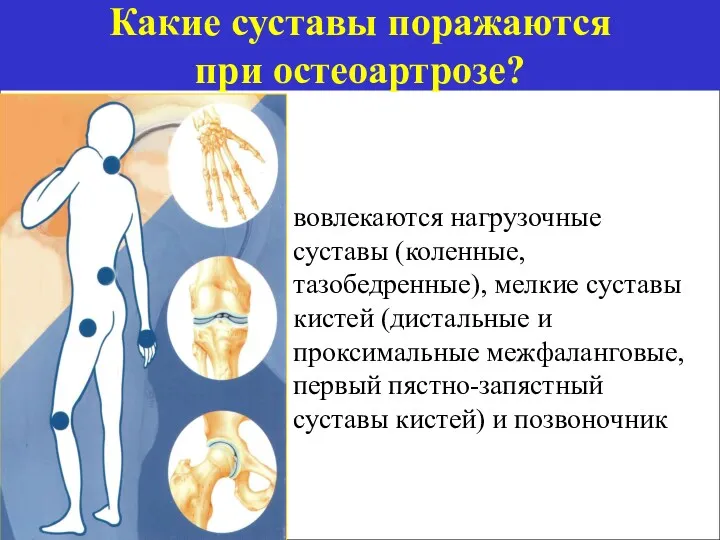 Какие суставы поражаются при остеоартрозе? вовлекаются нагрузочные суставы (коленные, тазобедренные), мелкие суставы кистей