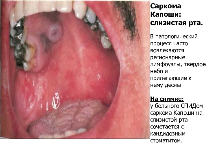 Саркома Капоши: слизистая рта. В патологический процесс часто вовлекаются регионарные