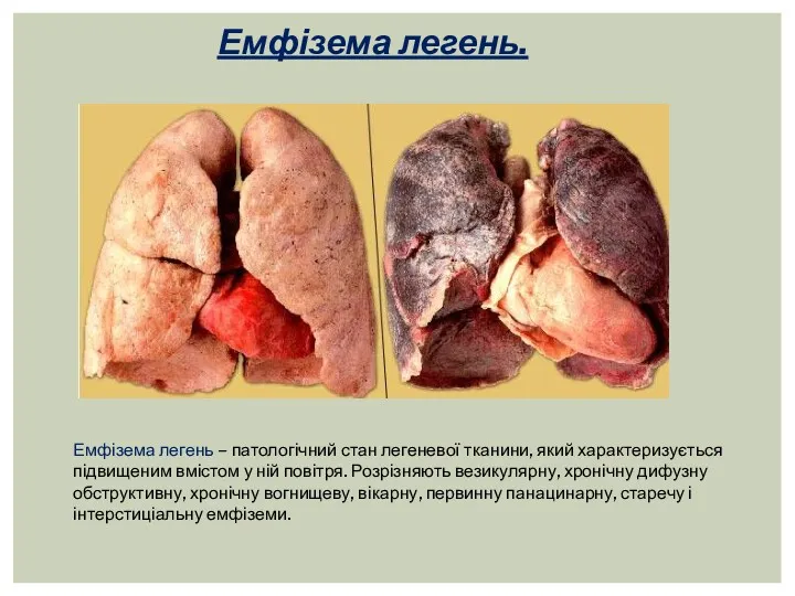 Емфізема легень. Емфізема легень – патологічний стан легеневої тканини, який