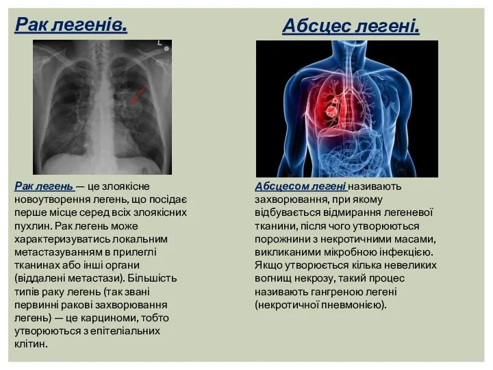 Рак легенів. Рак легень — це злоякісне новоутворення легень, що
