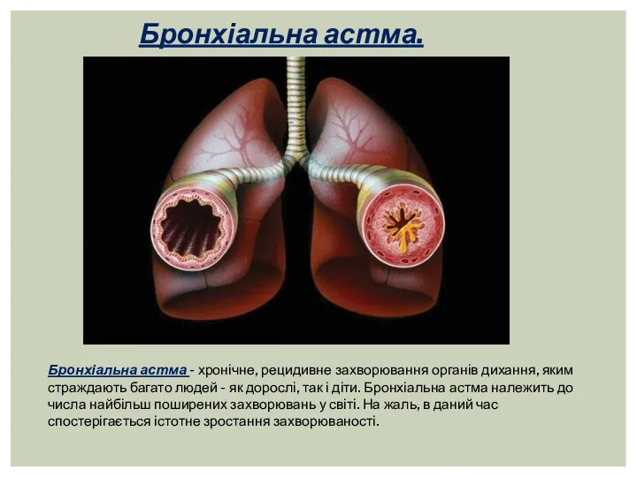 Бронхіальна астма. Бронхіальна астма - хронічне, рецидивне захворювання органів дихання,