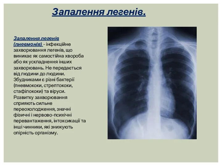 Запалення легенів. Запалення легенів (пневмонія) - інфекційне захворювання легенів, що