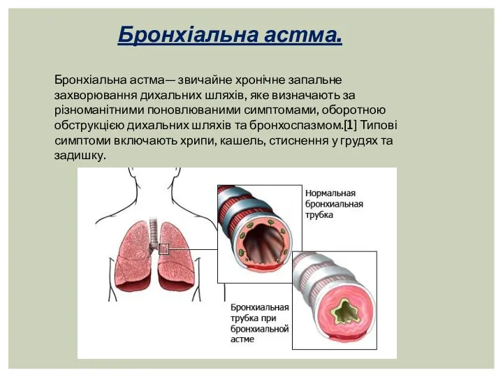 Бронхіальна астма— звичайне хронічне запальне захворювання дихальних шляхів, яке визначають