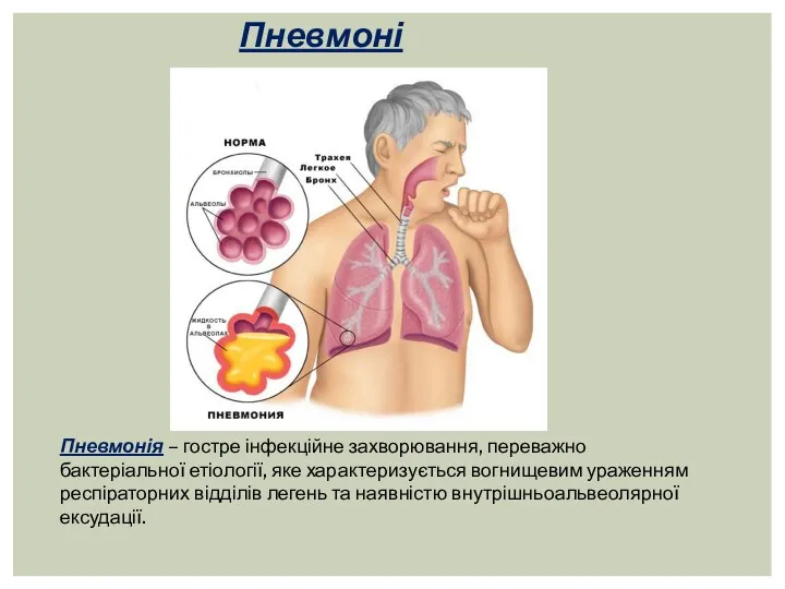 Пневмонія. Пневмонія – гостре інфекційне захворювання, переважно бактеріальної етіології, яке