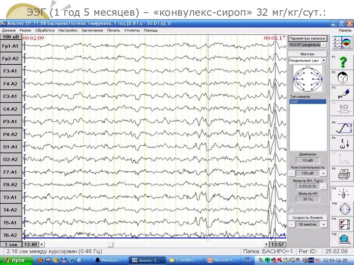ЭЭГ (1 год 5 месяцев) – «конвулекс-сироп» 32 мг/кг/сут.: