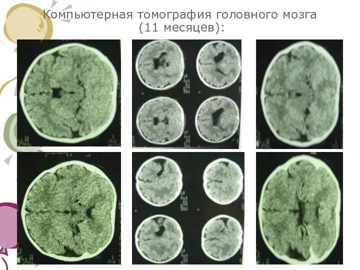 Компьютерная томография головного мозга (11 месяцев): .