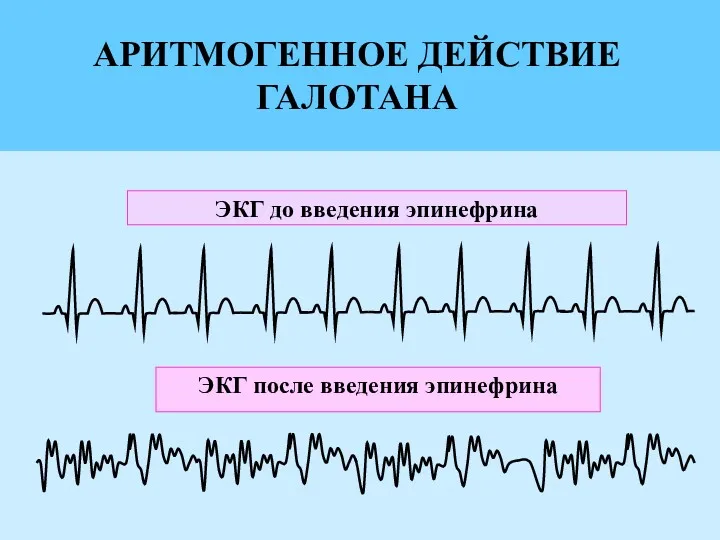 ЭКГ до введения эпинефрина ЭКГ после введения эпинефрина АРИТМОГЕННОЕ ДЕЙСТВИЕ ГАЛОТАНА