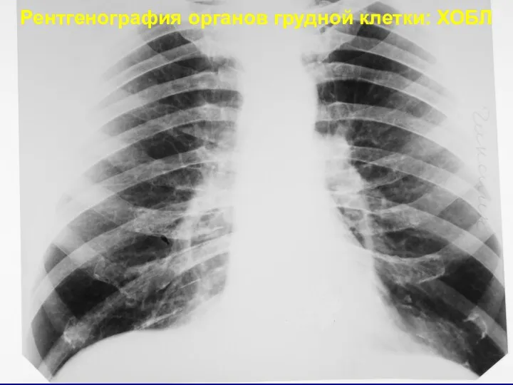 Рентгенография органов грудной клетки: ХОБЛ