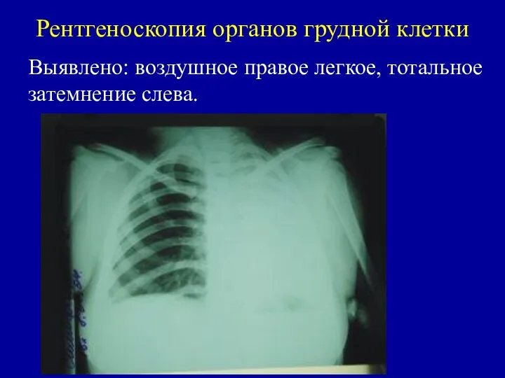 Рентгеноскопия органов грудной клетки Выявлено: воздушное правое легкое, тотальное затемнение слева.