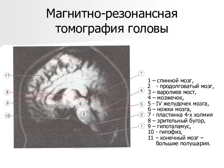 Магнитно-резонансная томография головы 1 – спинной мозг, - продолговатый мозг,