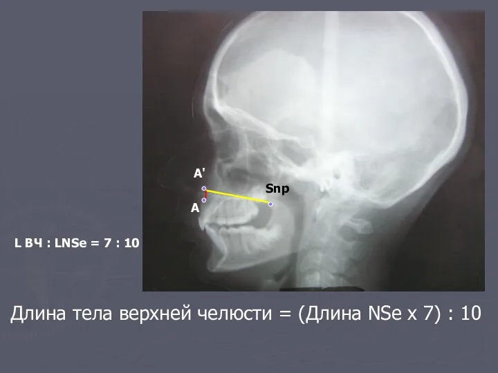 Длина тела верхней челюсти = (Длина NSe x 7) :