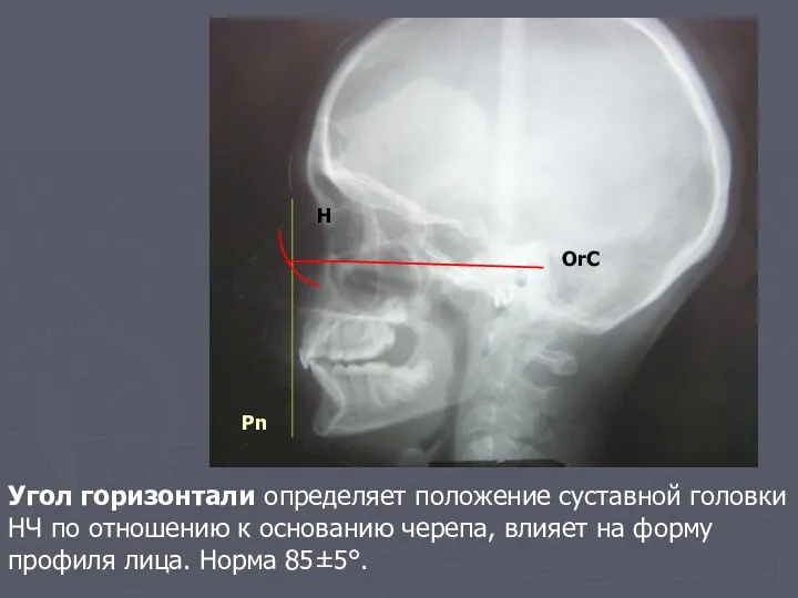 OrC Pn H Угол горизонтали определяет положение суставной головки НЧ