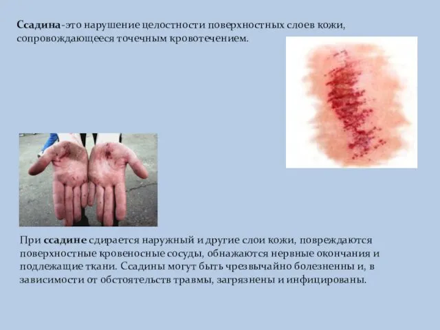 Ссадина-это нарушение целостности поверхностных слоев кожи, сопровождающееся точечным кровотечением. При